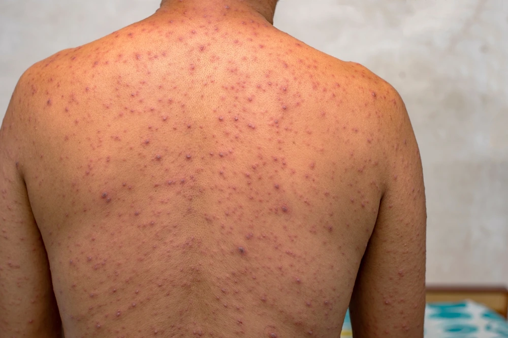 Pediatr: Suçiçəyi simptomatik müalicə ilə öz-özünə sağalır