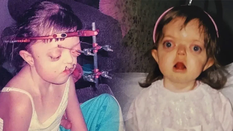 Nadir genetik xəstəliklə doğuldu, hər kəsi təəccübləndirdi