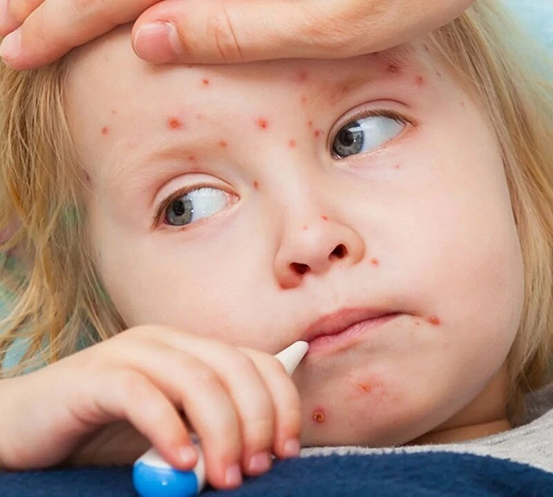 Azərbaycanda qızılca həyəcanı: Pediatr valideynləri dərhal peyvəndə çağırır!