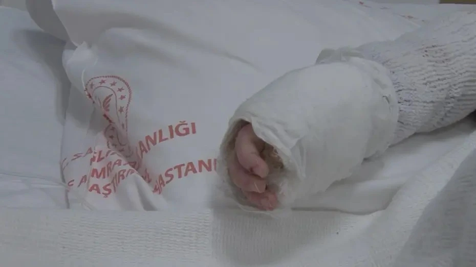 Üzərinə qaynar su tökülən 20 aylıq körpə evə buraxıldı