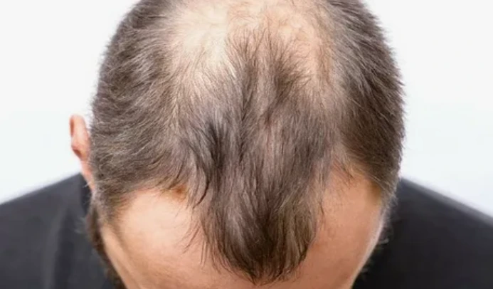 Kişilərdə saç tökülməsinə son: Yeni vasitə hazırlandı