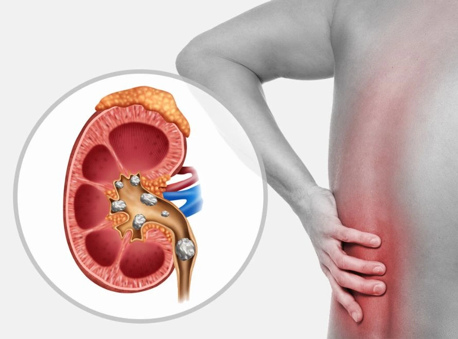 Böyrək daşı problemləri üçün ən çox tövsiyə olunan ot...