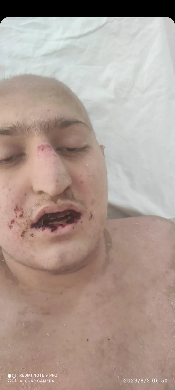 16 yaşlı Əjdər Quluzadə leykoz xəstəsidir, ana kömək istəyir -FOTOLAR