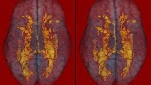 Balıq insulta səbəb ola bilərmi?