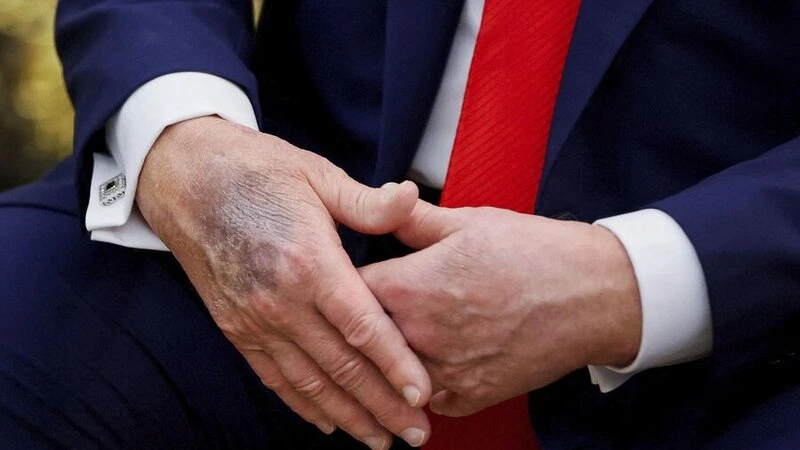 Tramp əllərindəki mavi ləkələrin səbəbini açıqladı