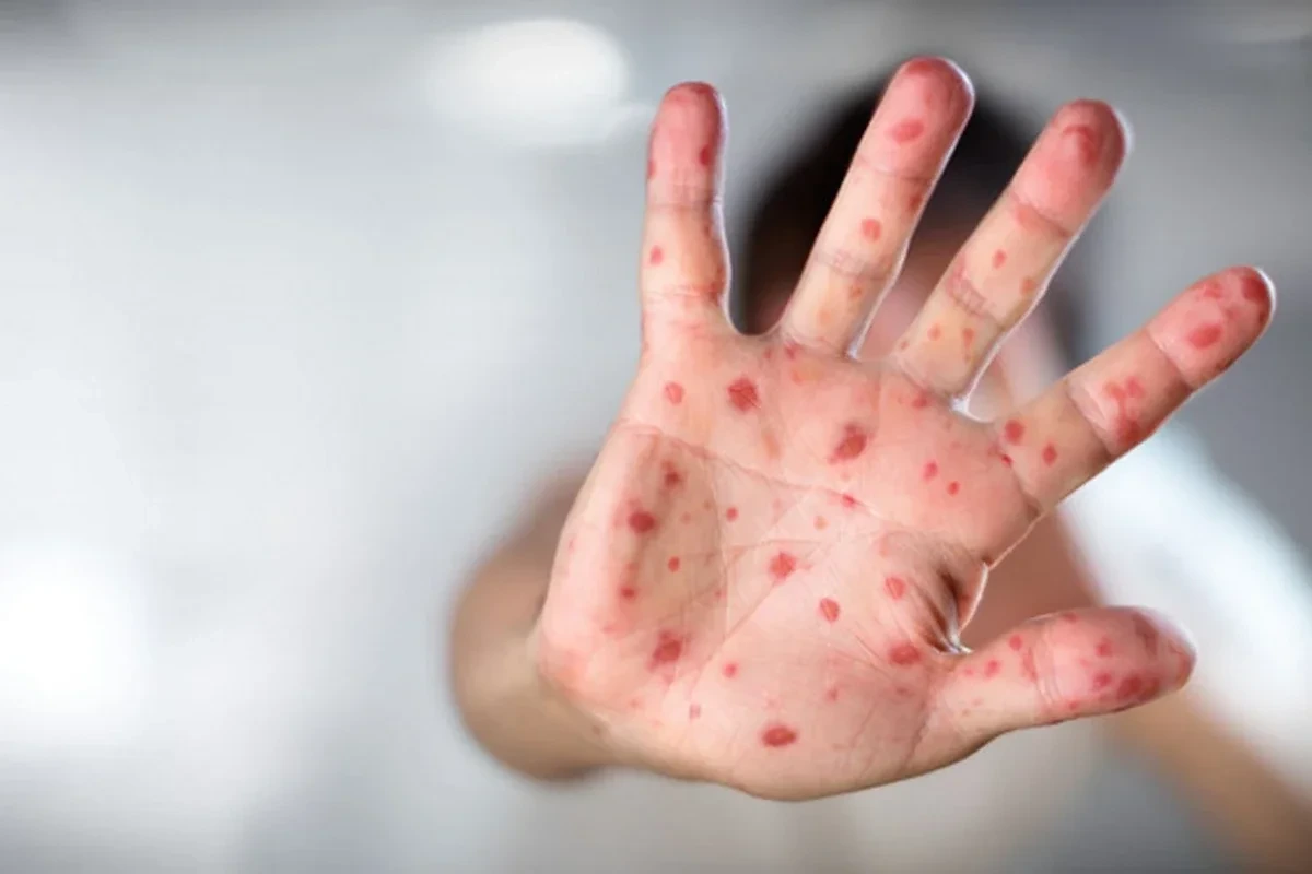 Hazırda Azərbaycanda qızılca və suçiçəyi ilə bağlı epidemioloji vəziyyət sabitdir - RƏSMİ