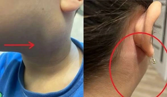 Qulaqdibi də qızılça və suçiçəyi kimi yoluxucu xəstəliklər sırasındadır - Professor