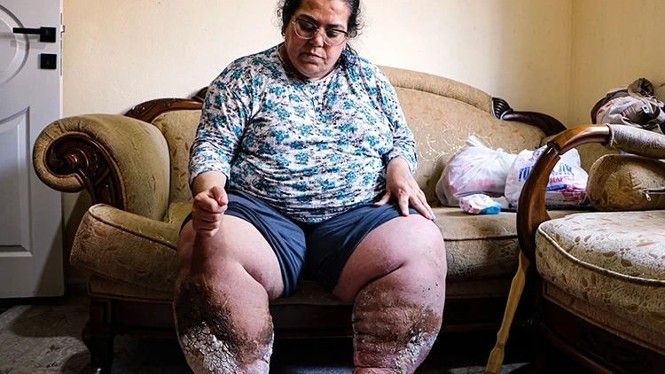 Fil xəstəliyindən əziyyət çəkən ananın fəryadı: “Yaralarım qurdlanır...” - FOTO