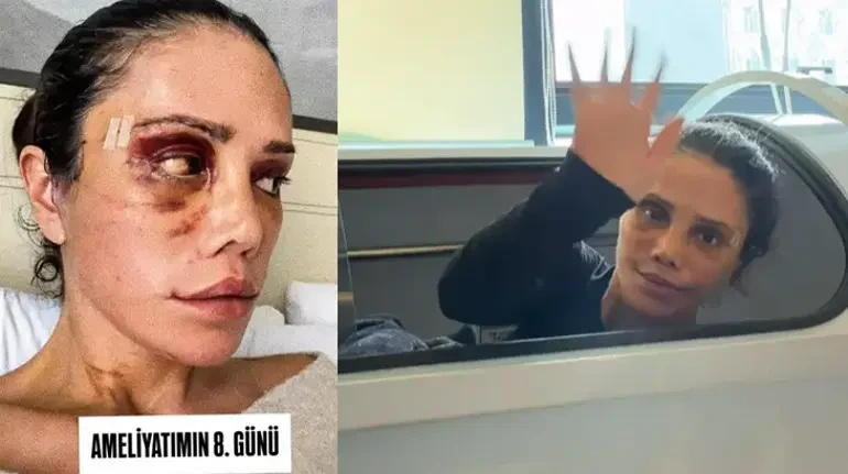 Üz əməliyyatı keçirən Didem Ceran HAMIDAN ÜZR İSTƏDİ