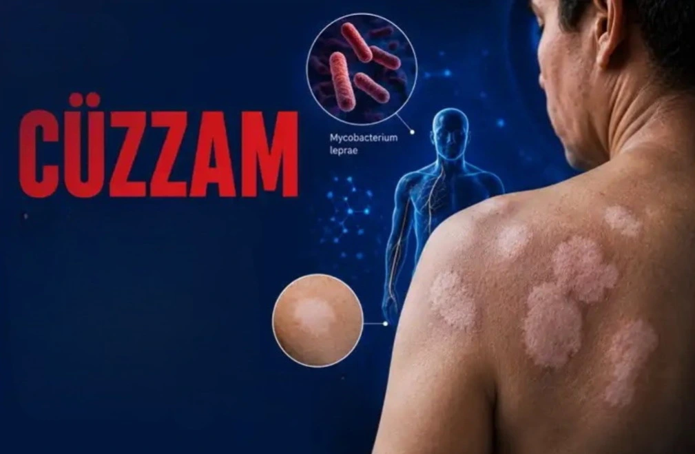 Cüzamla bağlı illərin qorxusu bitir - "Tam sağalmaq mümkündür” - Həkim terapevt